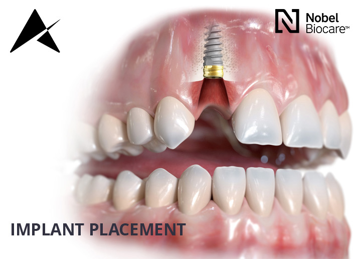 dental implants cork