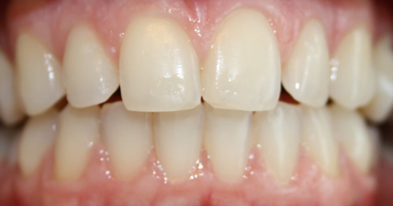 tooth whitening in Cork - Airport Dental Implant Centre Cork