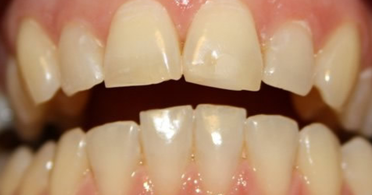 tooth whitening in Cork - Airport Dental Implant Centre Cork